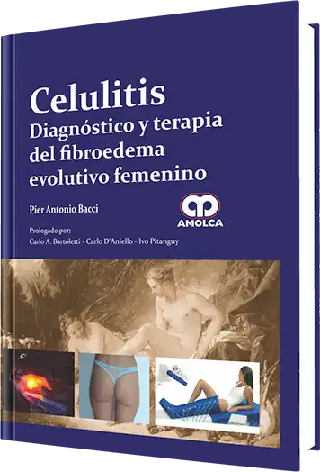 Celulitis. Diagnóstico y Terapia del Fibroedema Evolutivo Femenino