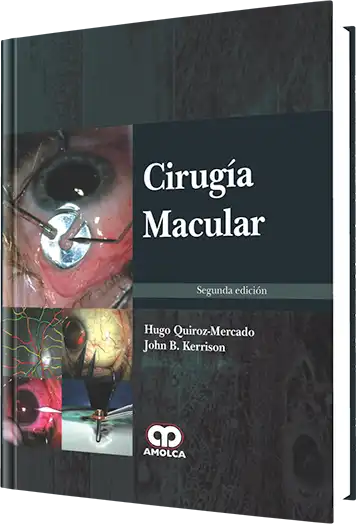 Cirugía Macular. 2 Edición