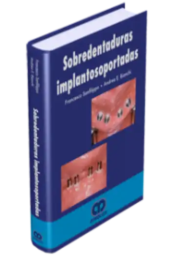 Sobredentaduras Implantosoportadas