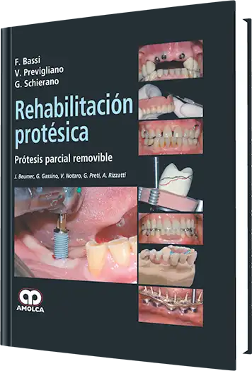 Rehabilitación Protésica. Prótesis Parcial Removible